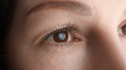 Katarak Bisa Mengganggu Penglihatan, Kenali Penyebab dan Kapan Perlu Ditangani